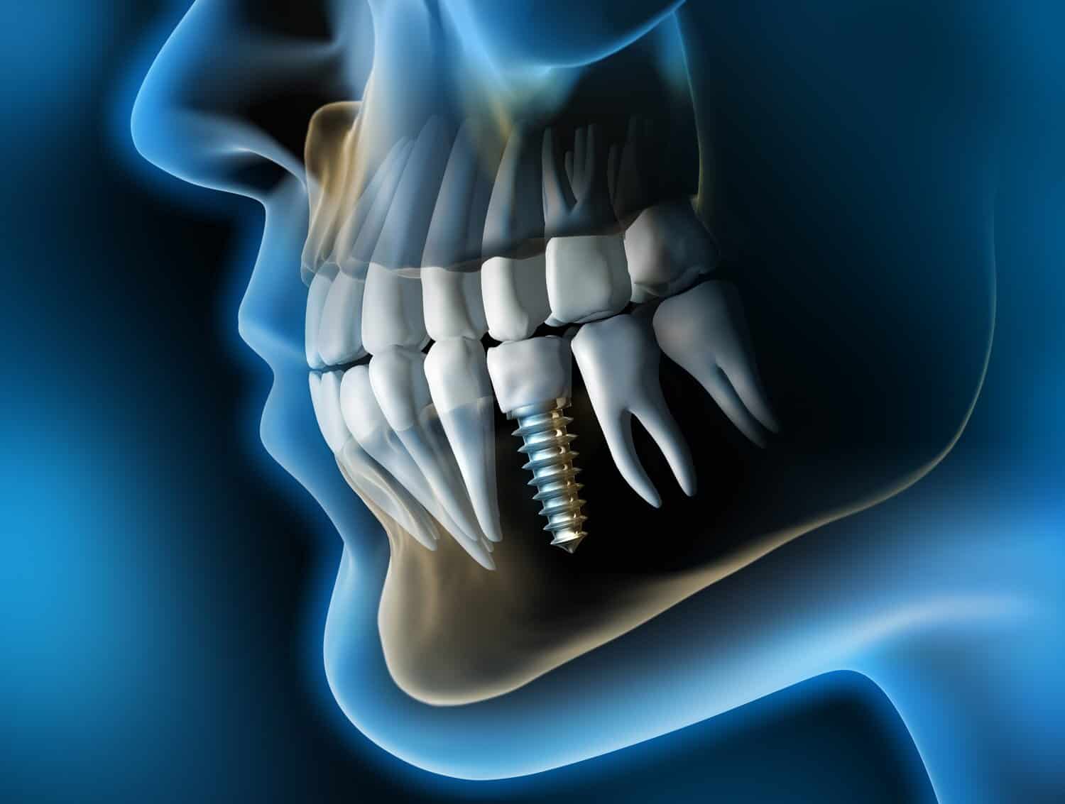 dental-implants-featured-image-1427132198