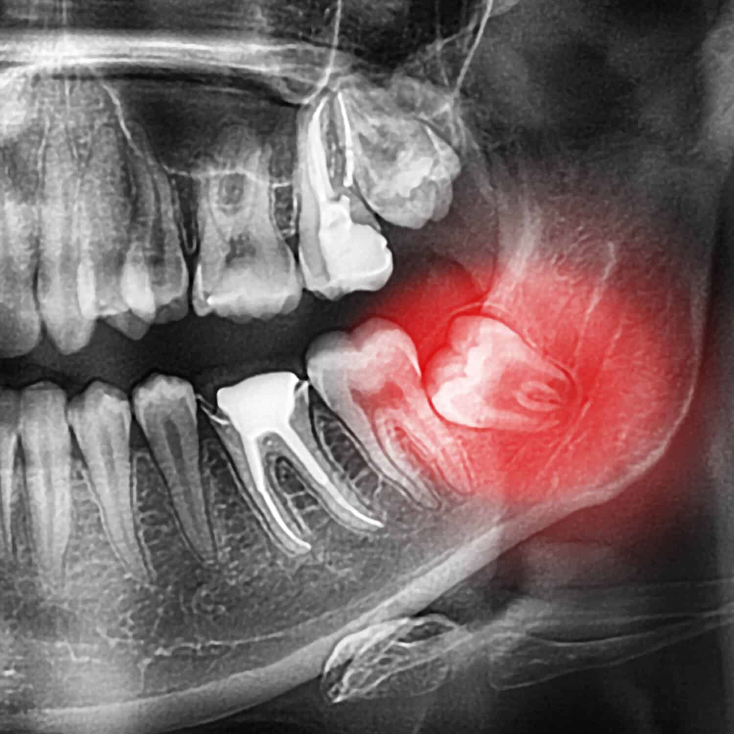 wisdom-teeth-featured-image-1306191280